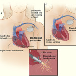 Pacemaker_NIH
