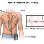 Anterior view male figure torso with holter monitor and ecg/heart rhythm inset; PCardio_20140402_v0_005

SOURCE: cardio_holter-monitor_proc_1_layers.psd